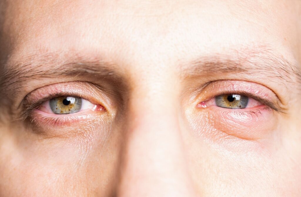 Close-up of a man's eyes, red and swollen due to allergies